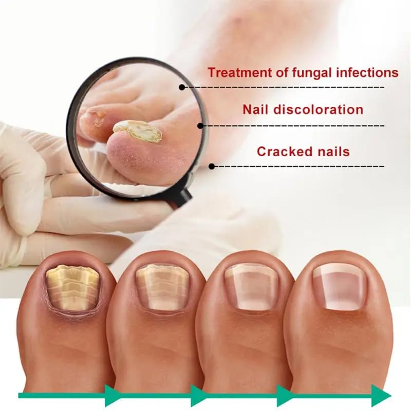Nail Fungus Treatment Serum - Image 3
