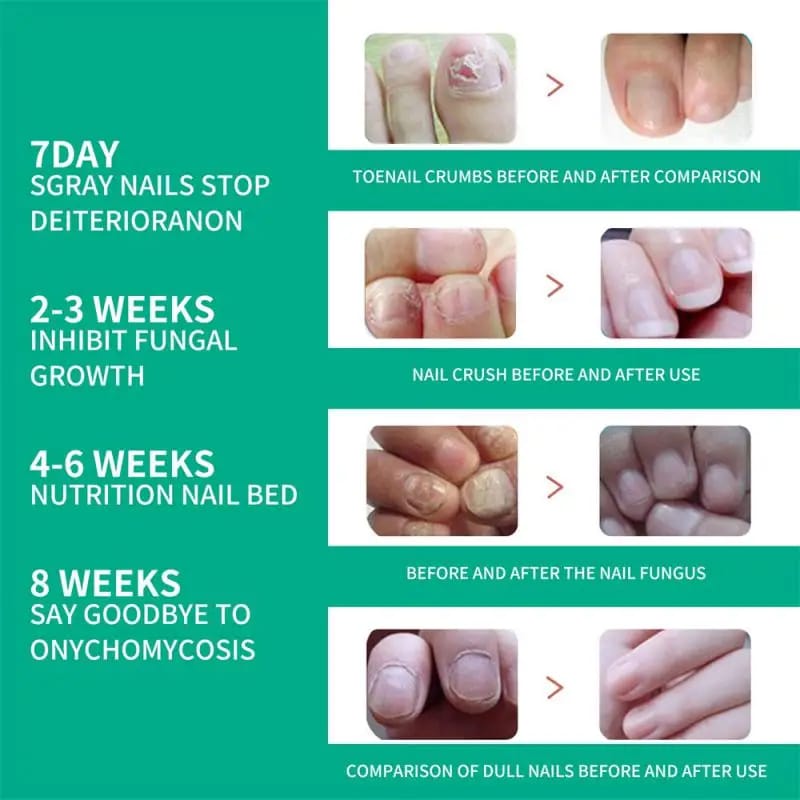 Nail Fungus Treatment Serum - Image 7