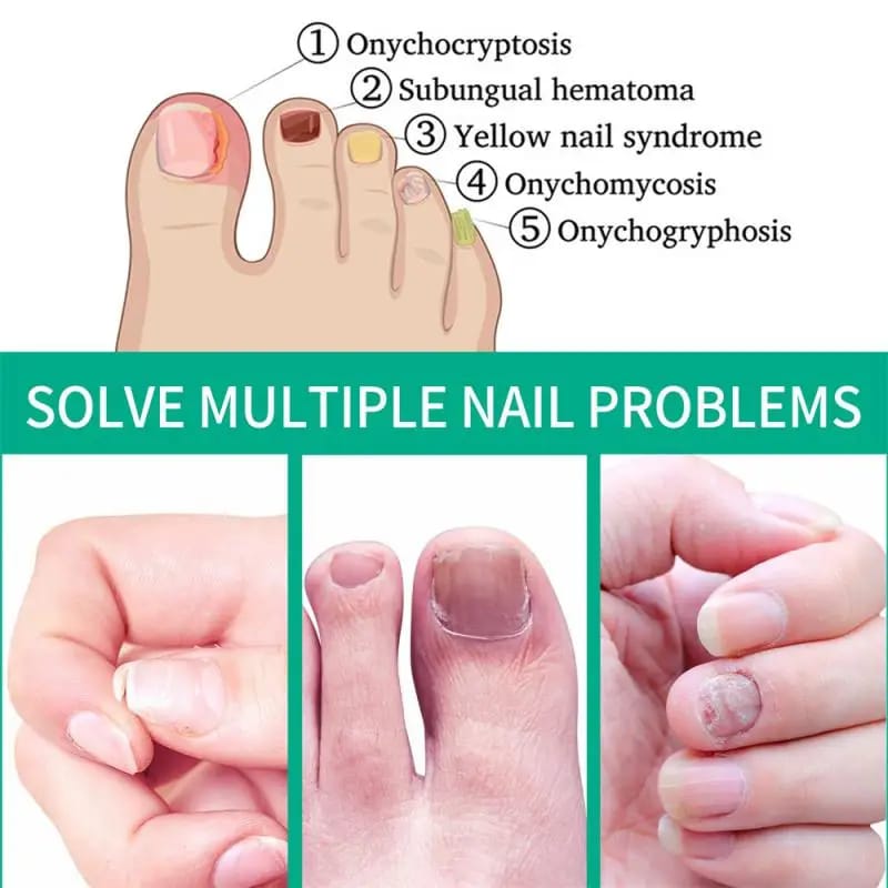 Nail Fungus Treatment Serum - Image 4